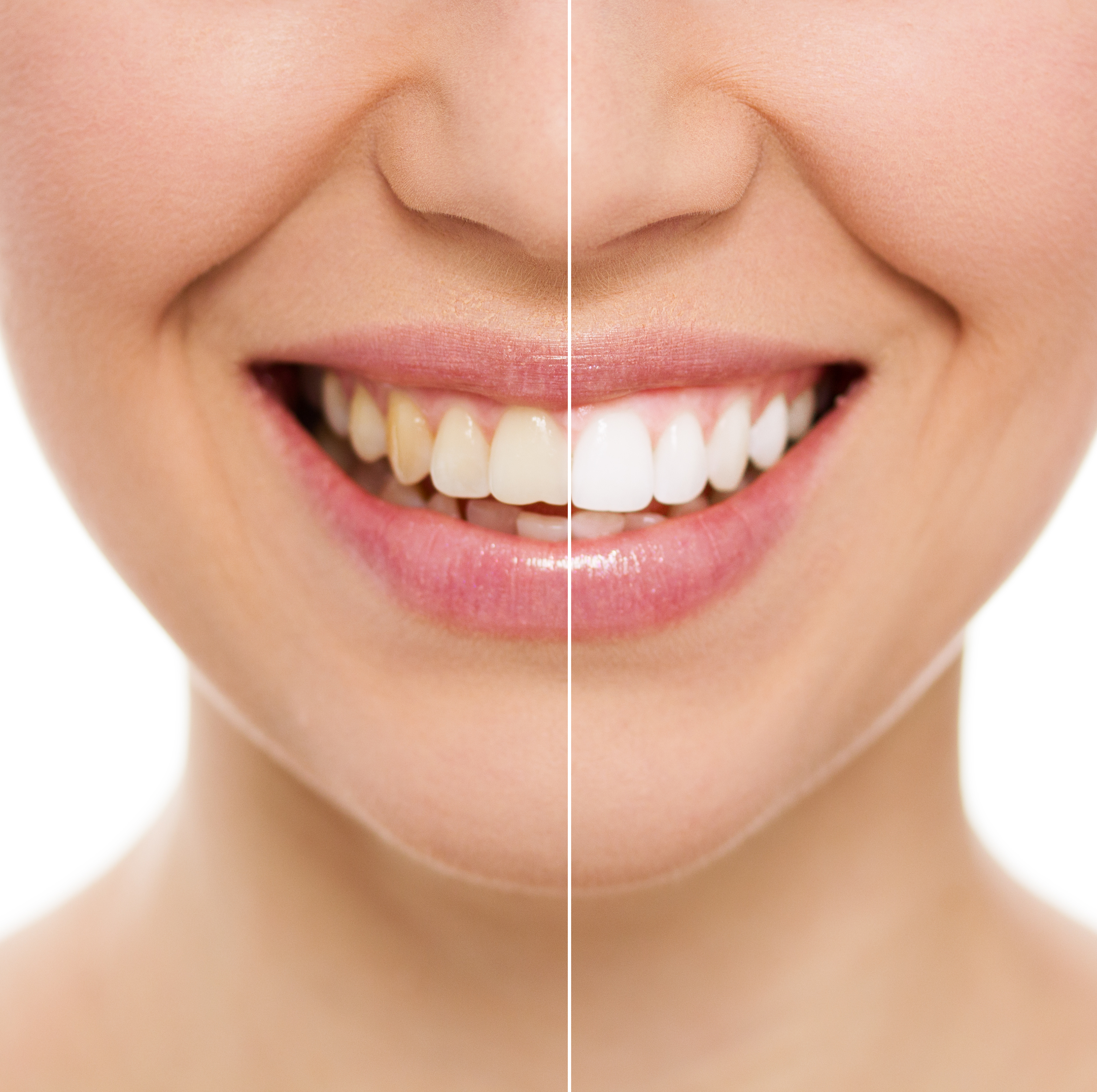 5 Most Popular Styles For Teeth Whitening Kiosks In 2022